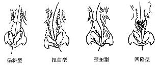 鼻中隔偏曲是如何诱发的