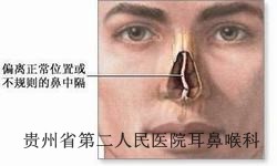 鼻中隔偏曲有哪些症状