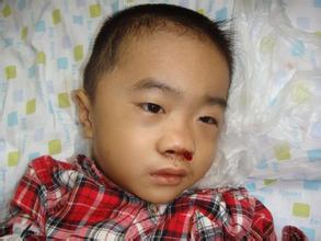 鼻出血对人体的影响