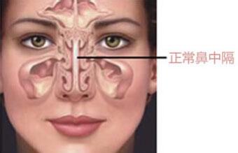 鼻中隔偏曲的危害