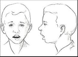 腺样体肥大该如何检查
