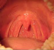 腺样体肥大对儿童的危害