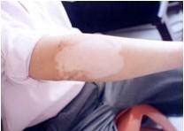 武汉手部白癜风有治吗 武汉手部白癜风有治吗