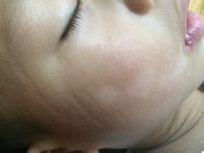 武汉哪家医院治白斑较好 武汉哪里可以治白斑