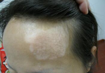 武汉哪个医院治白癜风较好 武汉哪家医院可以治白癜风