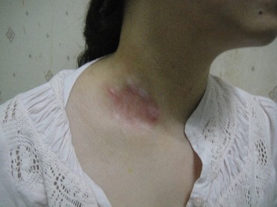 武汉308激光治疗白癜风要多少钱 武汉治疗白癜风价格