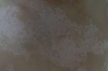 武汉儿童医院看白癜风吗?早期白癜风的主要症状有哪些 武汉哪个医院看白癜风比较好?早期白癜风的症状有哪些